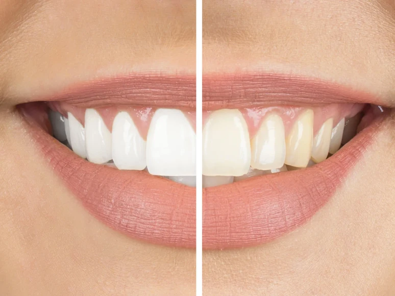 Side-by-side close-up of a patient's smile before and after professional teeth whitening
