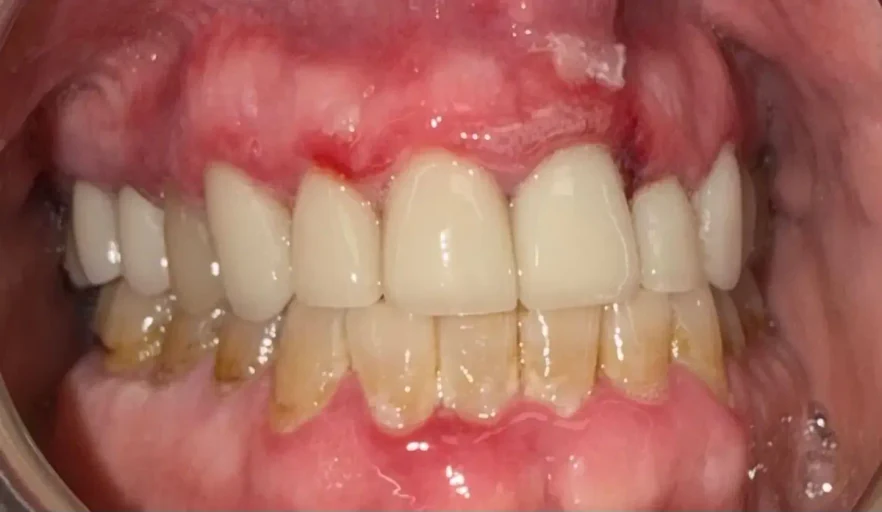 After photo of the same patient's smile